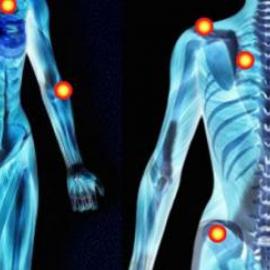 Fibromyalgie: Wie damit leben?